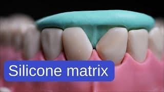 Silicone index technique for tooth restorations