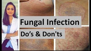 Fungal infection of skin | Do's and Don'ts | Dermatologist | Dr. Aanchal Panth