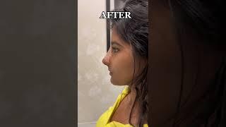 Revision Rhinoplasty for my beautiful patient from India  #rhinoplasty #nosejob #india