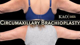 KAO Plastic Surgery Arm Lift Without The Huge Scars - Circumaxillary Brachioplasty - Arm Tightening