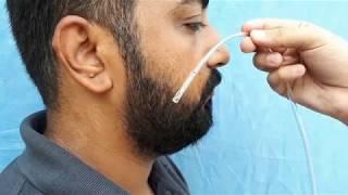 NASOGASTRIC INTUBATION -RYLES TUBE (FEEDING TUBE INSERTION)