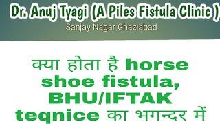 क्या होता horse shoe भगन्दर, इस तरह के fistula में BHU / IFTAK  Teqnice से ईलाज हुआ आसान।.आइये जाने!