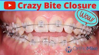 Amazing Open Bite - Before and After - Clear Braces