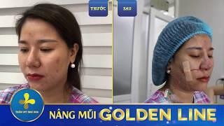 Muốn gì được nấy với dịch vụ #nâng_mũi_Golden_Line tại Dr.Tống Hải.