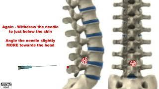 "Walking the needle in" on Lumbar Puncture