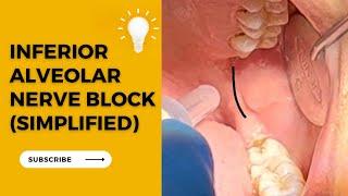 Inferior Alveolar Nerve Block (step by step)