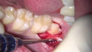 lower third molar extraction