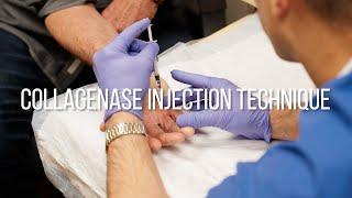 Collagenase Injection Technique for Dupuytren's Contracture