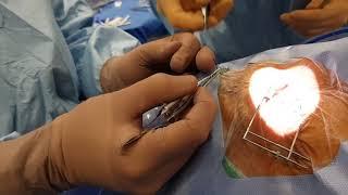 traction suture tying technique at beginning of Preserflo (or tube shunts)