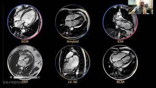 Master Class On- Interpretation of Cardiac MRI