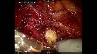 AUA Urology Teaching Videos: Robotic repair of left uretero-neobladder anastomotic stricture