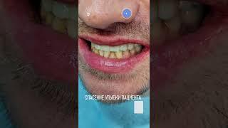 Спасение улыбки пациента. Saving the patient's smile.#dentist