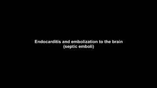 Endocarditis and Stroke - by Cal Shipley, M.D.