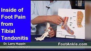 Inside of Foot Pain and Posterior Tibial Tendonitis Treatment – Seattle Foot Doctor