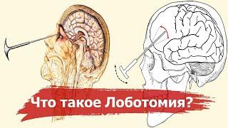 Lobotomy - the nightmare of the 20th century | The history of the most terrible operation