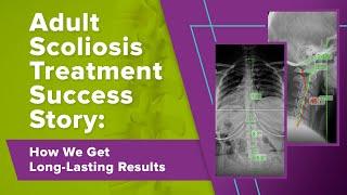 Adult Scoliosis Treatment Success Story: How We Get Long-Lasting Results