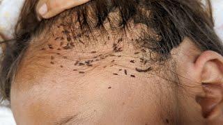 How to get out all hundred lice from short hair - Remove thousand lice from head