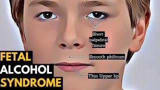 Fetal Alcohol Syndrome, Causes, Signs and Symptoms, Diagnosis and Treatment.