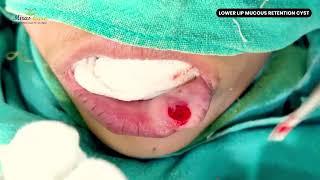 Lower lip mucous retention cyst | Day Care Surgery | Fast Recovery | Best General Surgeon in India