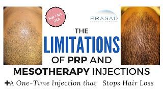 Limitations, Ineffectiveness of PRP, Mesotherapy Hair Loss Treatments, and a Better Alternative