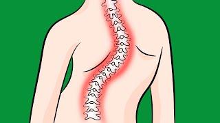 How to Fix Idiopathic Scoliosis Naturally