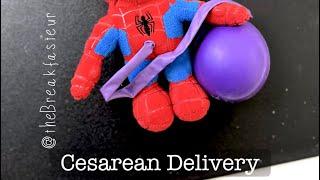 Playdough Surgery - Cesarean Delivery