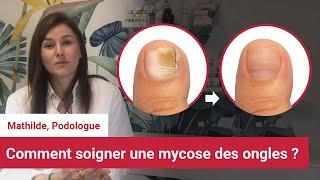 Soigner et reconnaitre la mycose des ongles des pieds  ? Conseil d'une podologue