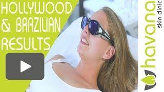 Laser Hair Removal Brazilian Reviews