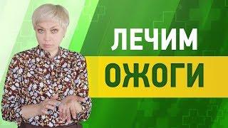 Как лечить ожог/6 простых домашних средств.