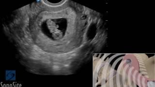 How To: Pathology Ectopic Pregnancy 1st Trimester TV 3D Video