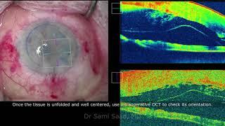 DMEK Cornea Transplant Surgery - Dr Sami A. Saad