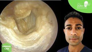 1,288 - Dead Skin Peel off Surgical Tympanoplasty Eardrum