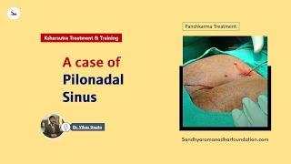 A case of Pilonadal Sinus || Dr. Vikas Gupta || Sandhya Raman Adhar Foundation