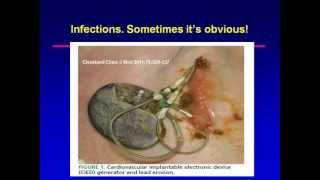 Preventing and Treating Implantable Device Related Infections and Lead Failures - kchrs2011