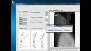 Measuring the Kyphotic Angle in Radiography