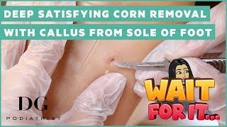 Deep satisfying corn removal with callus from sole of foot