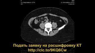 Расшифровка КТ брюшной полости выявило грыжу Бохдалека и гепатомегалию