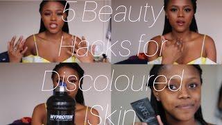 5 Hacks for discolored skin | Yasmin Buachie