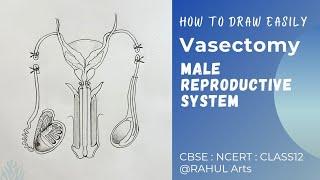 How to Draw Vasectomy | Male Reproductive System