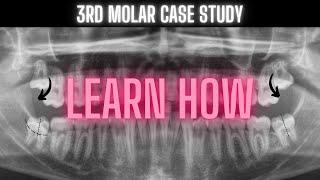 Third Molar Impaction Video | Learn How | OnlineExodontia.com