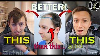 My Thoughts on my Hair Transplant