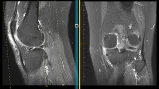 How to diagnose a meniscus tear