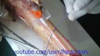 Venous cutdown procedure