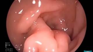 Upper Gastrointestinal Endoscopy: Examination Technique and Standard Findings