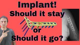 Should the implants be removed after the fracture healed?