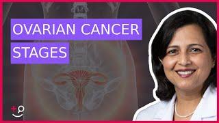 The 4 Stages of Ovarian Cancer by Dr. Ruchi Garg