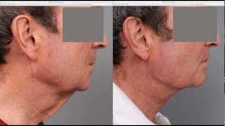 Neck Lift For Men | Dr. Sterry