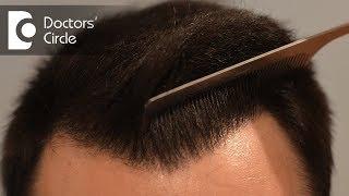 How many hair transplant grafts do you need to cover bald areas? - Dr. Deepak P Devakar