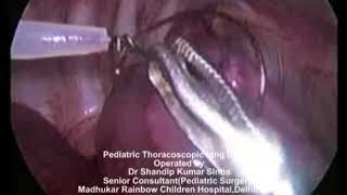 Pediatric Thoracoscopic lung biopsy by Dr Shandip Sinha,Pediatric Surgeon