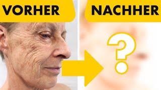 Mein bestes Facelift aus 3000 OP's! 5 Eingriffe in nur einer OP | Facelift, Halslift, Augenlider...